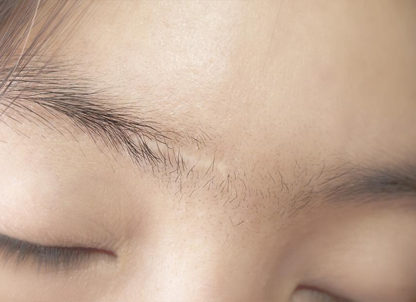 Cicatrizes nas sobrancelhas - como revestir?